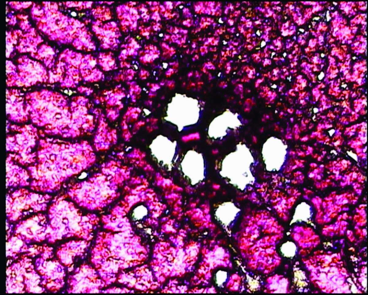 Dry blood analysis slide used for the oxidative stress test
