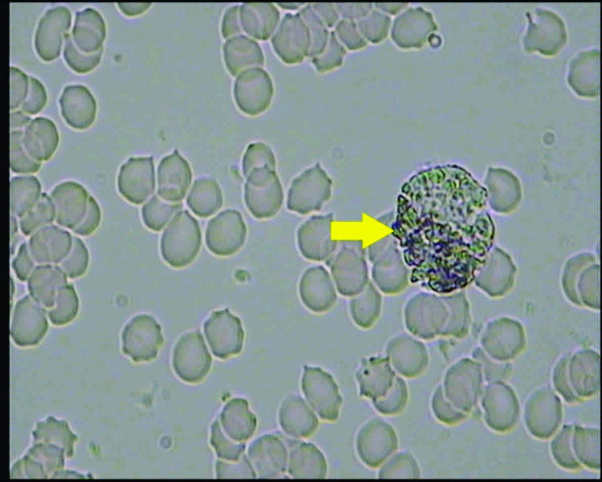 Live blood analysis under the microscope showing red blood cells