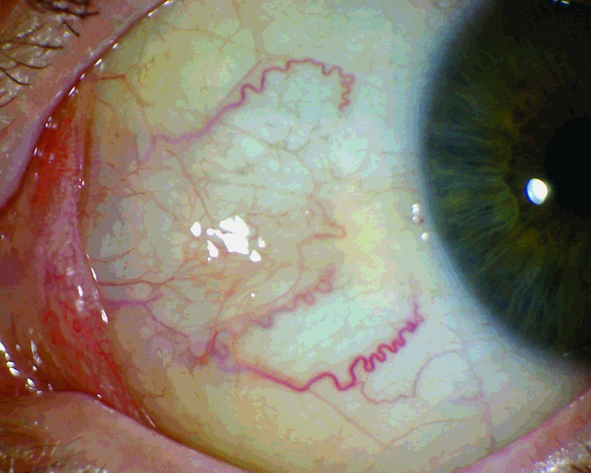 Sclerology - red vessel markings in the white of the eye, read at The Holistic Oak, Port Alfred